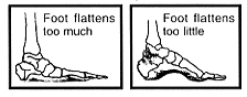 flat feet plantar fasciitis planter fascitis
